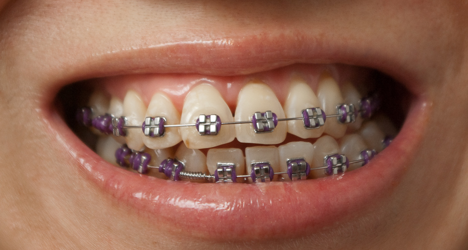purple-braces