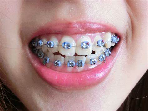 light-blue-braces