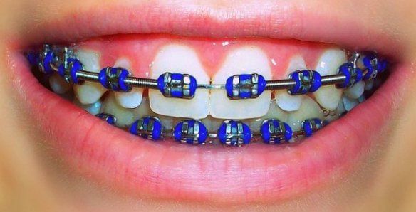 blue-braces