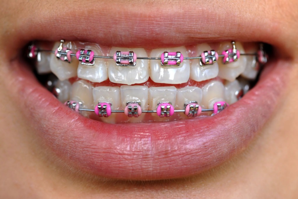 pink-braces
