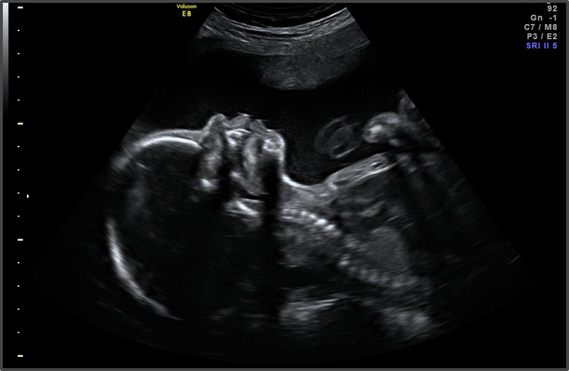 24-Week-Ultrasound?